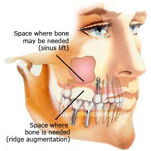 Impacted Sinus