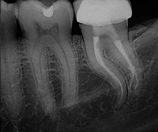 Root Canal Treatment | American Dental Center